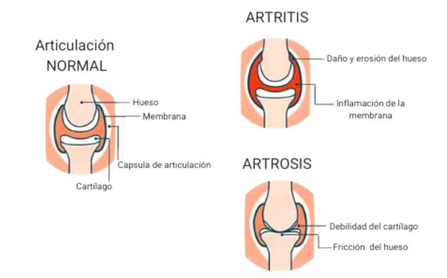 artrosis y cartílagos